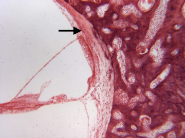 Immunohistochemical visualization of hyalinization