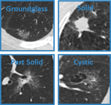 Lung Nodules Scanned