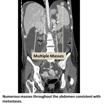 Numerous masses throughout the abdomen consistent with metatstases.