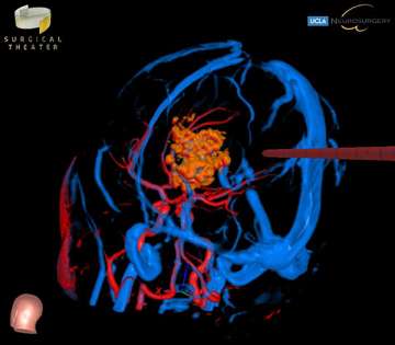 Image of Pineal Region Tumors