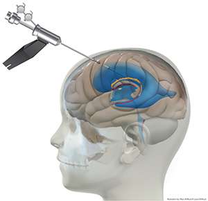 Graphic of Hydrocephalus procedure