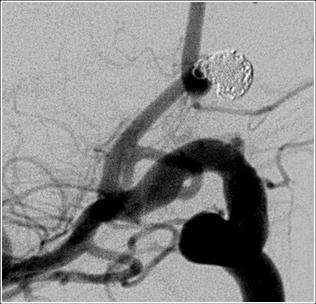 Figure 4. After Treatment: Bleeding is arrested using detachable coil.