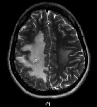 Sinus Thrombosis 2