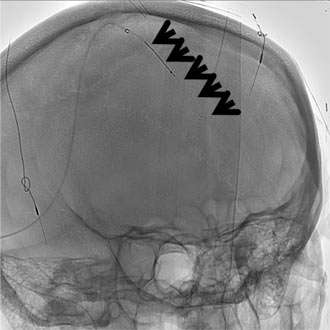 Sinus Thrombosis 3