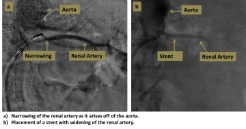 Two step diagram of stent graft placement process