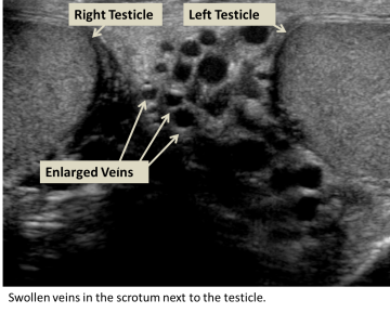 Swollen veins in the scrotum next to the testicle