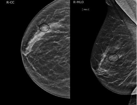 Case: Invasive Lobular Carcinoma Figure 1