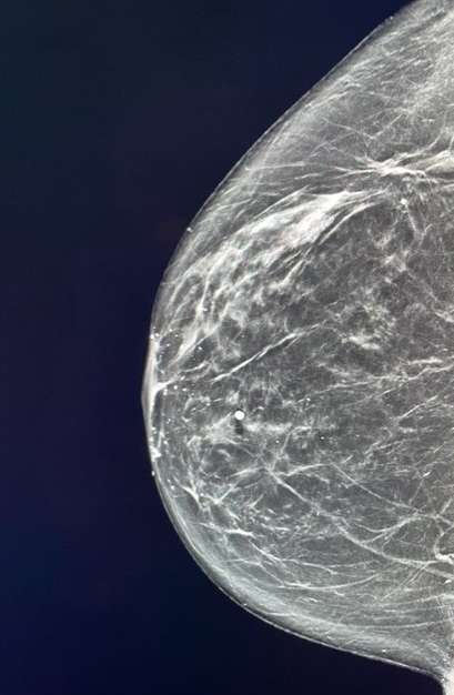 Case: Lymphoma of the Breast Figure 1