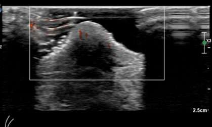 Case: Paget's Disease Figure 2