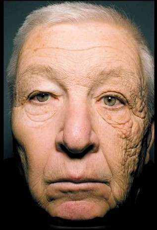 Older man's face showing stark asymmetry: right side heavily wrinkled and leathery