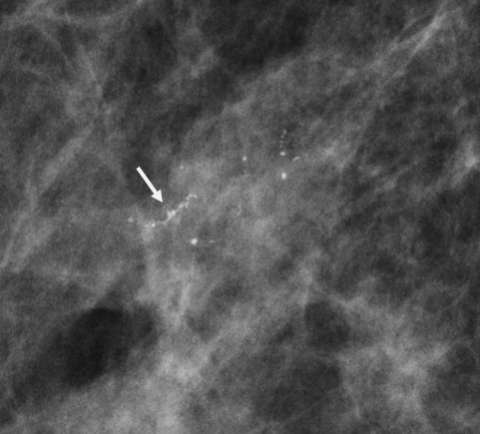 Case: Ductal Carcinoma In Situ Figure 1