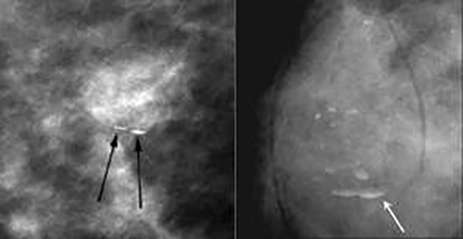 Milk of calcium calcifications: True lateral views
