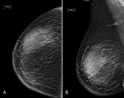 Case: Seromas and Hematomas Figure 2