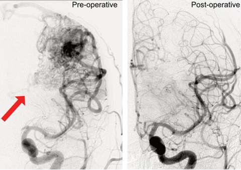 Pre-operative and post-operative medical images of vascular structures, with highlighted changes.