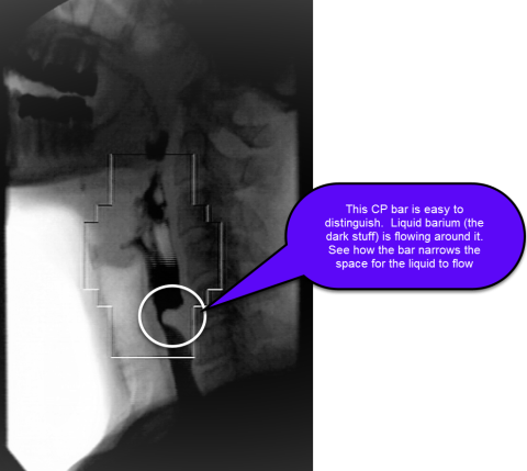 Cricopharyngeal Bar
