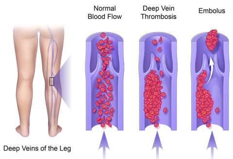 DVT Diagram