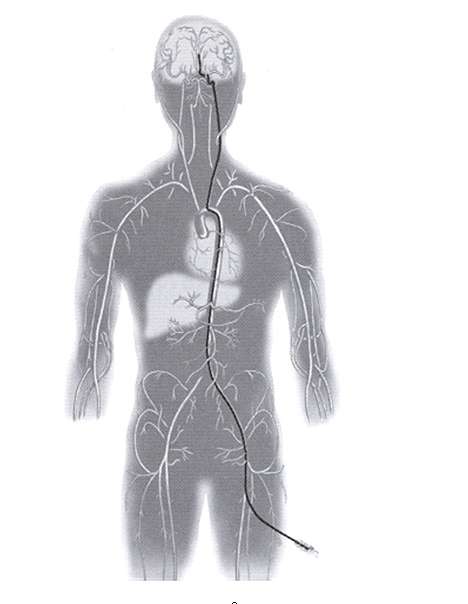 Embolization