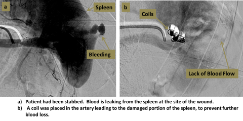 Two step diagram of embolization process