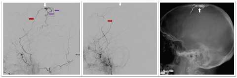 Panel of images showing skull x-ray and Dural Arteriovenous Fistula Embolization