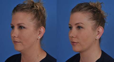 kybella