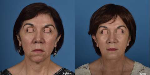 facelift