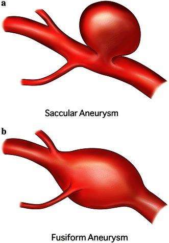 Brain Aneurysm