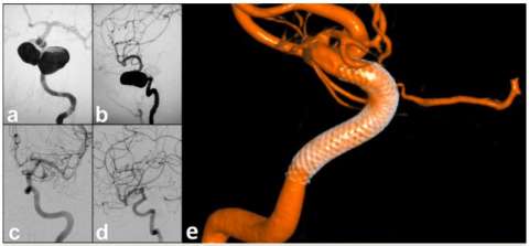 giant left internal carotid artery