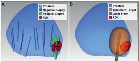 Region of interest identified via MRI with cancer confirmed via targeted biopsy