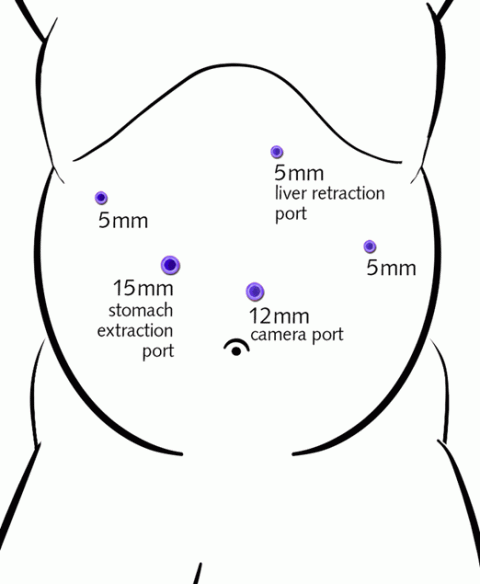 Gastric Sleeve Illustration