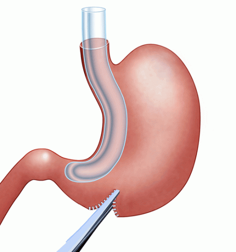 Gastric Sleeve Illustration