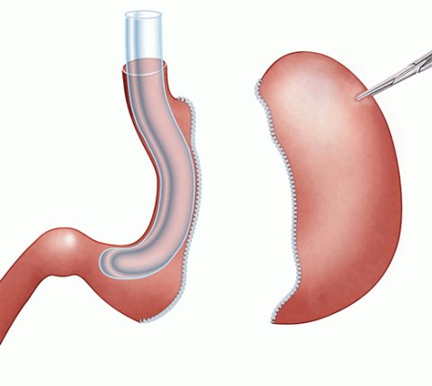 Gastric Sleeve Illustration