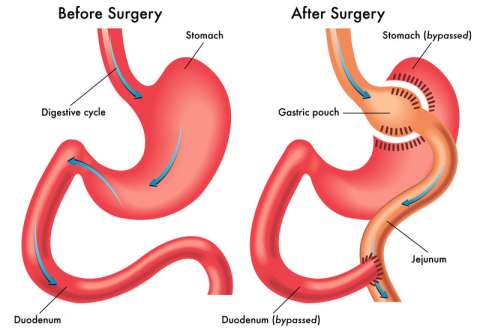 Gastric Bypass Illustration