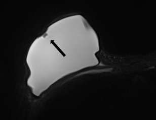 Axial short tau inversion recovery (STIR)