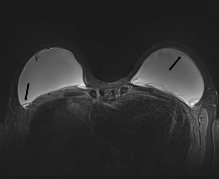 Axial STIR MRI with arrows demonstrating subcapsular lines of bilateral intracapsular ruptures.