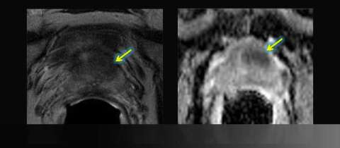 MR-Guided Targeted Biopsy