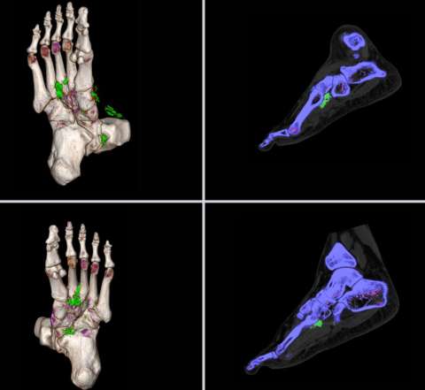 Gout Analysis