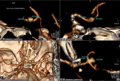 Brain Aneurysms