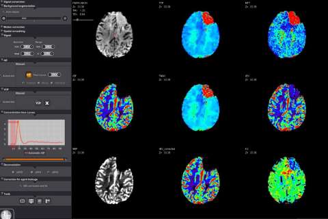 Brain Perfusion