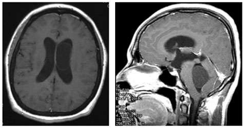 Neurocysticercosis