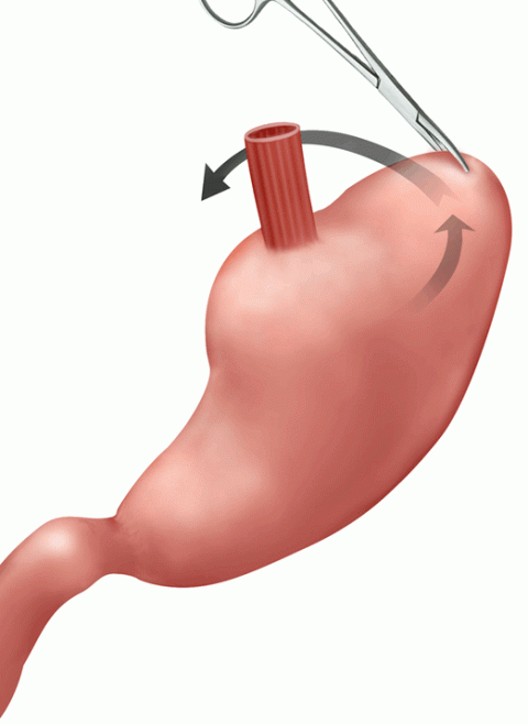 Nissen fundoplication Illustration for GERD (Reflux disease)