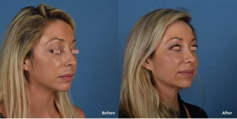 rhinoplasty