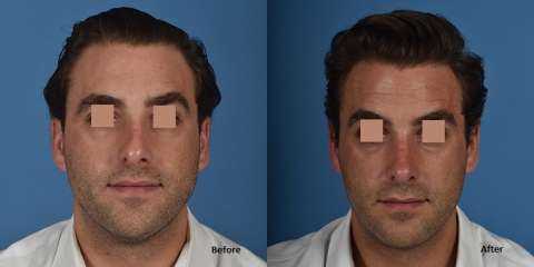 rhinoplasty