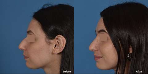 rhinoplasty