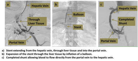 Three step diagram of Transjugular Intrahepatic Portosystemic Shunt process