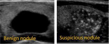 Thyroid Nodules