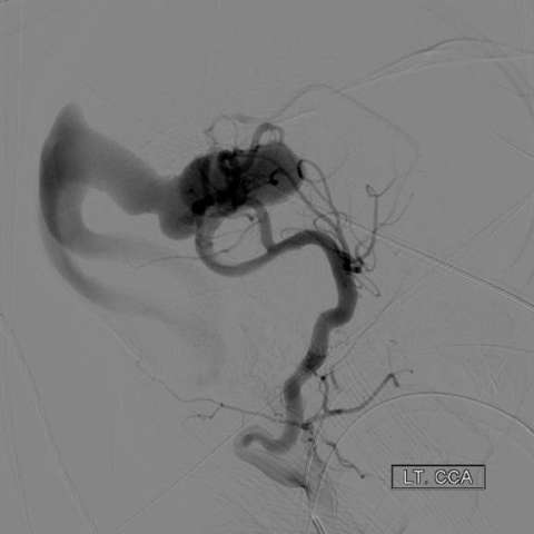 VGM2 - Cerebral angiogram