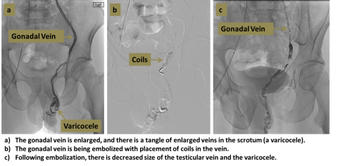 Varicocele Embolization diagram in three steps