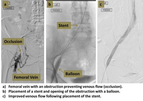 Venous thrombolysis recanalization diagram in three steps