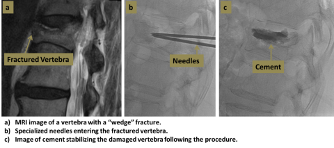 Three step diagram of vertebroplasty process