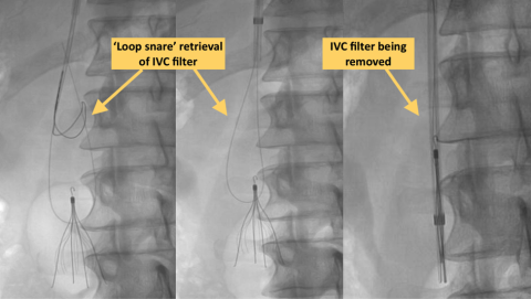 X-ray diagram of Advanced Filter Removal
